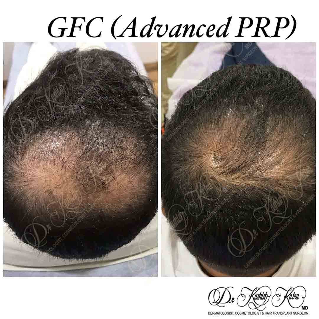 Advanced PRP Treatment in Delhi (GFC) Hair Loss Treatment in Delhi
